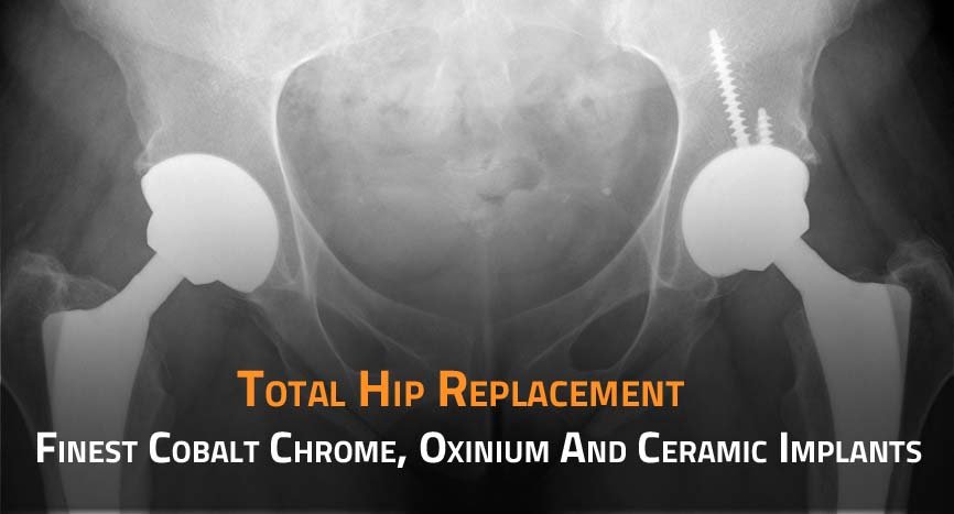 Total Hip Replacement